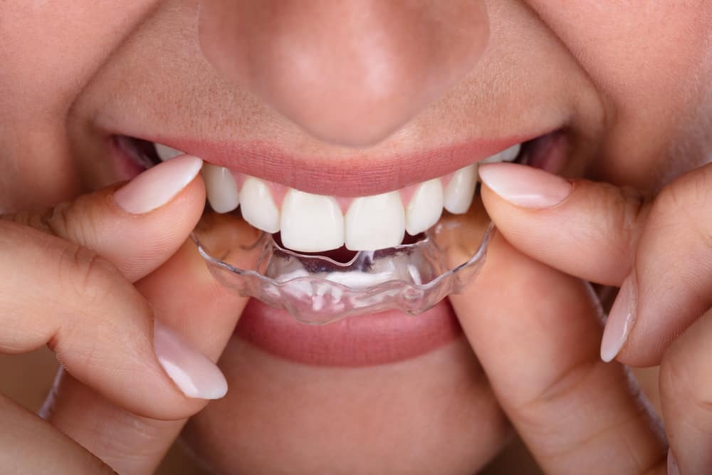 Mouth Guard Davie Florida